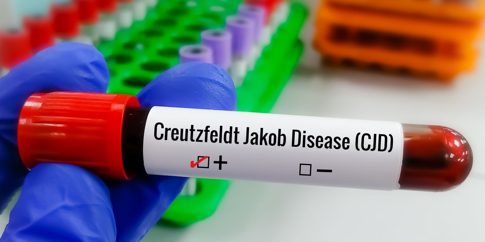 Doença de Creutzfeldt-Jakob: o que é, sintomas, diagnóstico e pesquisas; caso Lito Souza traz tema à tona